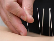 acupuncture1