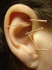 Earacupuncture